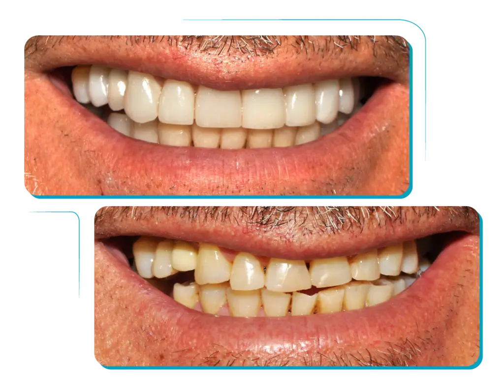 Sonrisa Premium | Dentanova Cínica Odontológica en Ñuñoa